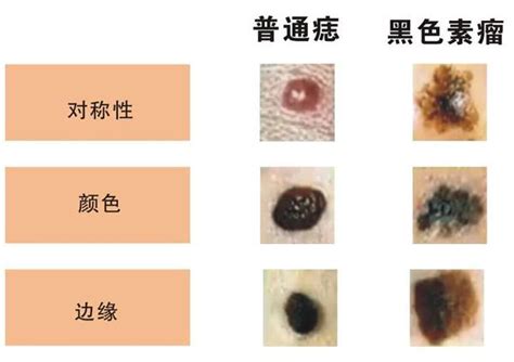 為什麼會長黑痣|是痣還是瘤？黑色素瘤的類型、症狀與治療